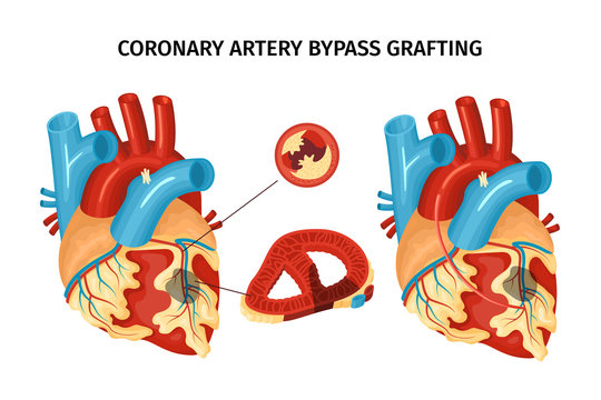 Consult with best Bypass Surgeon in Delhi Dr. Vaibhav Mishra