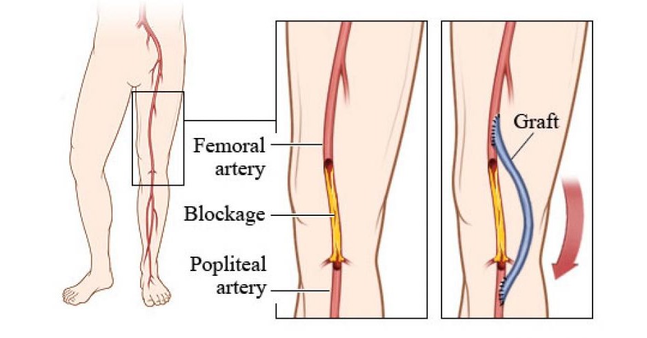 Peripheral Vascular Bypass Surgery